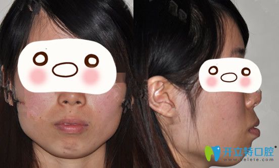 沒(méi)有找廣州圣貝口腔熊飛做正畸前的臉型照片