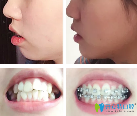 齙牙怎么矯正？曬泰安光彩口腔鋼絲矯正齙牙1-10個(gè)月變化圖