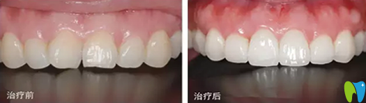 嘉興曙光口腔牙齒美容冠修復治療前后對比圖 嘉興曙光口腔牙齒美容冠修復治療前后對比圖