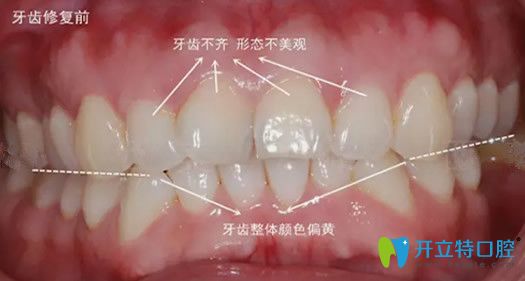 在嘉興曙光口腔做牙齒美容修復前 在嘉興曙光口腔做牙齒美容修復前