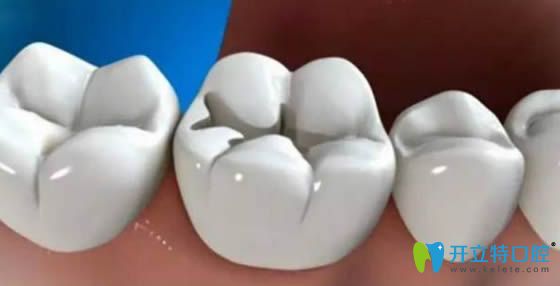 樹(shù)脂補(bǔ)牙能用多久