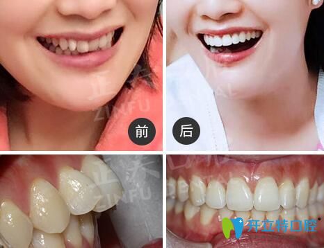 深圳正夫口腔正畸怎么樣？看多組正夫口腔牙齒矯正評價