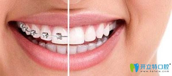 列舉深圳牙齒矯正好且正規(guī)的口腔機(jī)構(gòu),附價(jià)格表及顧客評(píng)價(jià)