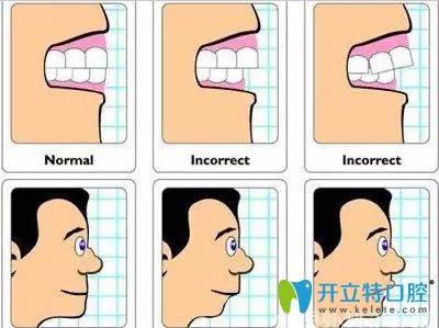 鐘紅醫(yī)生表示對于兒童錯頜畸形應(yīng)采取早期預(yù)防和干預(yù)治療