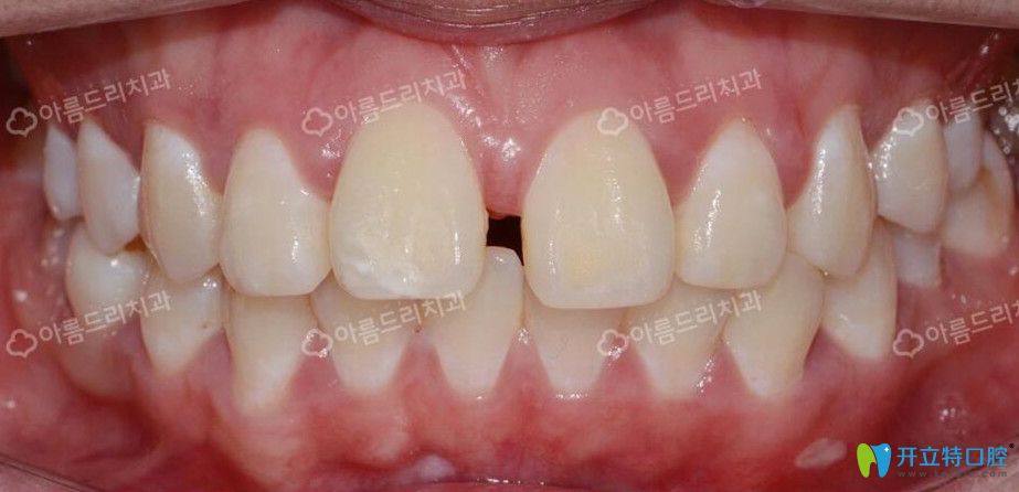 韓國牙科水平怎么樣?安特麗牙科種植矯正案例及評價(jià)供參考