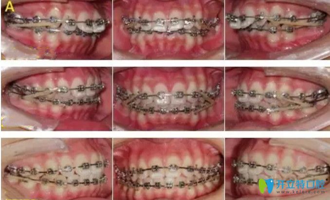 一位47歲大姐來(lái)談她使用全同步帶狀弓矯正牙齒的感受