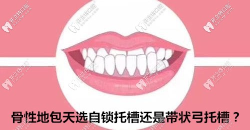 據(jù)說骨性地包天用全同步帶狀弓矯正比戴自鎖牙套好?真or假