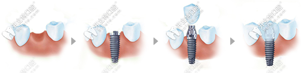 種植牙的過程示意圖