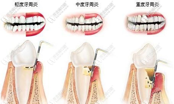 上海哪里有丹麥水冷激光治療，大概需要多少費(fèi)用？