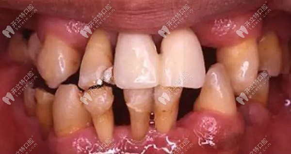 牙齦突然無(wú)緣無(wú)故出血,當(dāng)心是牙周炎在作祟！